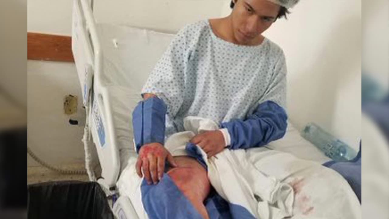 Joven del Valle necesita 32 mil dólares para regresar de México luego de sufrir grave accidente