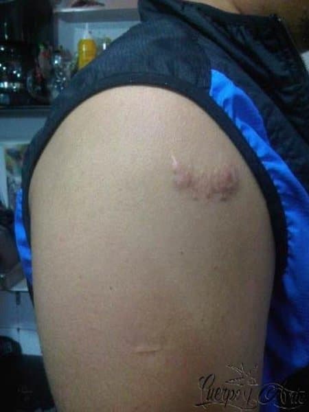 Tatuajes para cubrir cicatrices: Anthonil comparte su experiencia