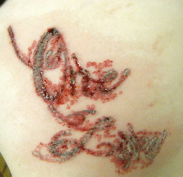 Tatuajes borrados con láser