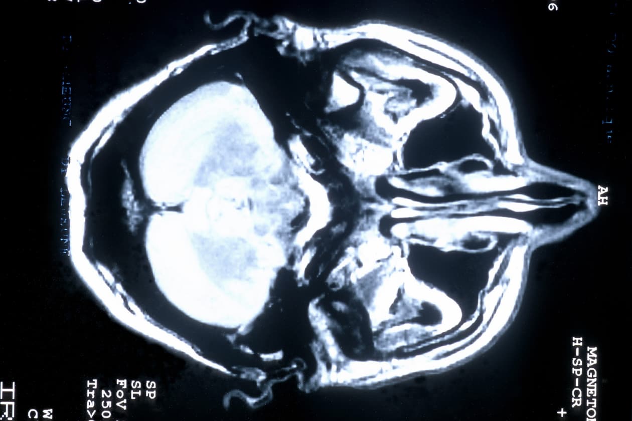 Científicos desarrollan droga para evitar recuerdos traumáticos