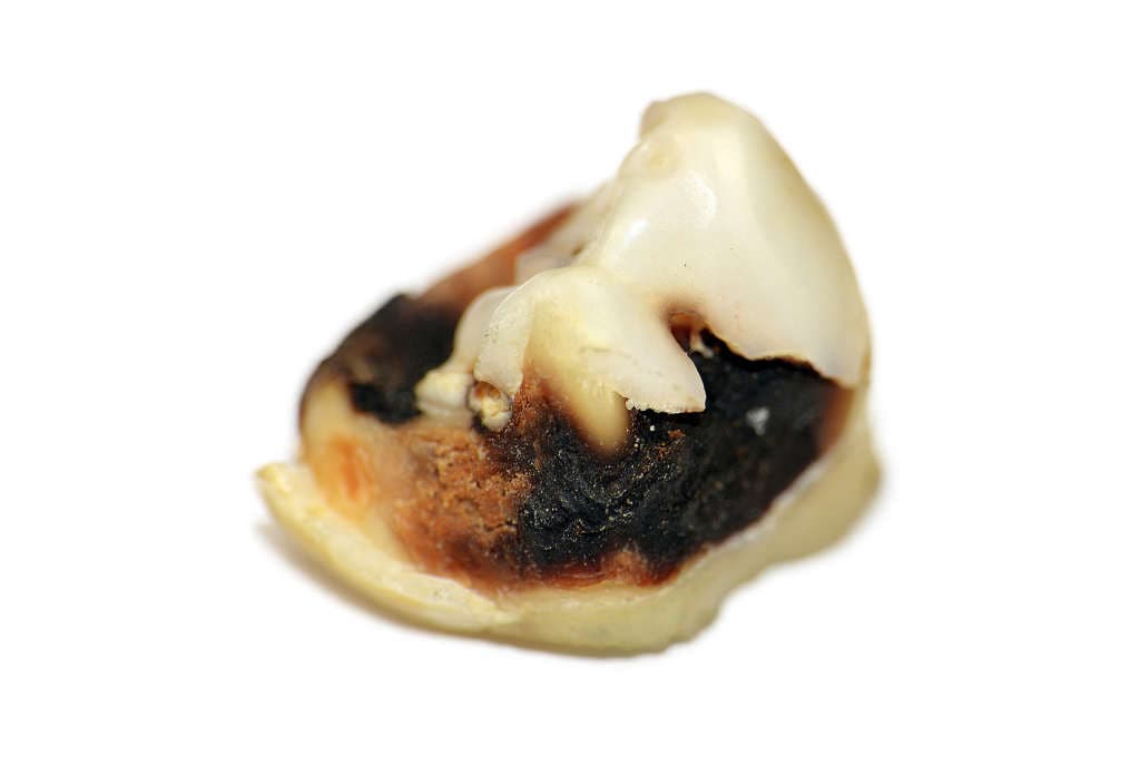 ¿Cómo se forman las caries?