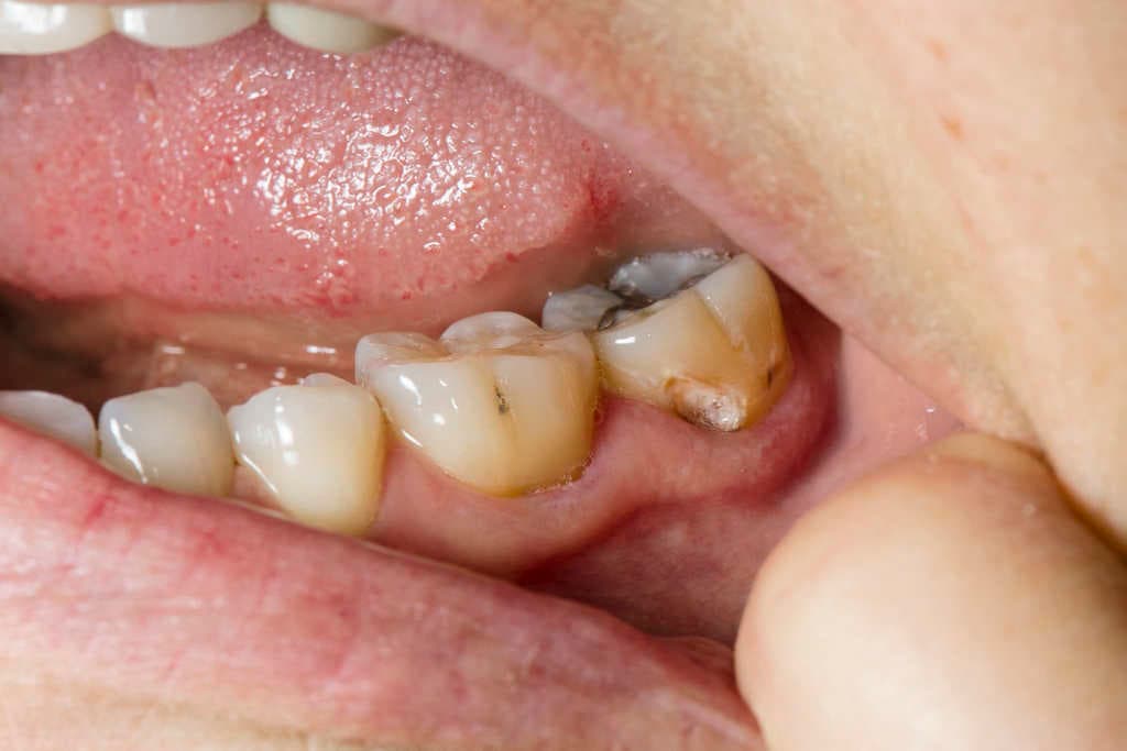 Un nuevo medicamento curará las caries sin sufrir una dolorosa sesión con el dentista