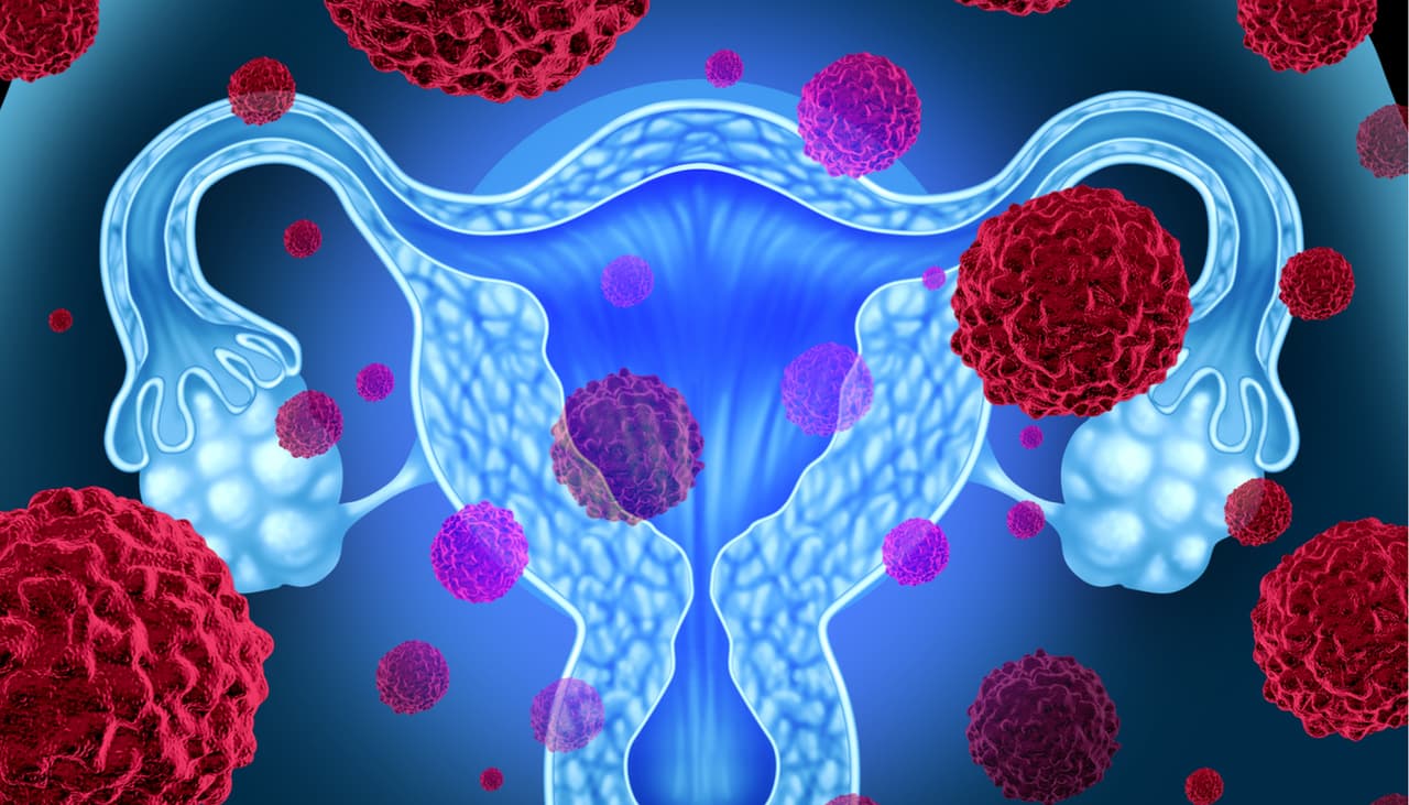 Adenomiosis uterina: la enfermedad que se confunde con cólicos comunes