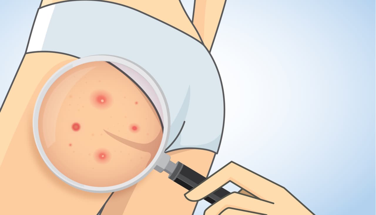 3 remedios caseros para un derrière libre de imperfecciones (dermatólogas los aprueban)