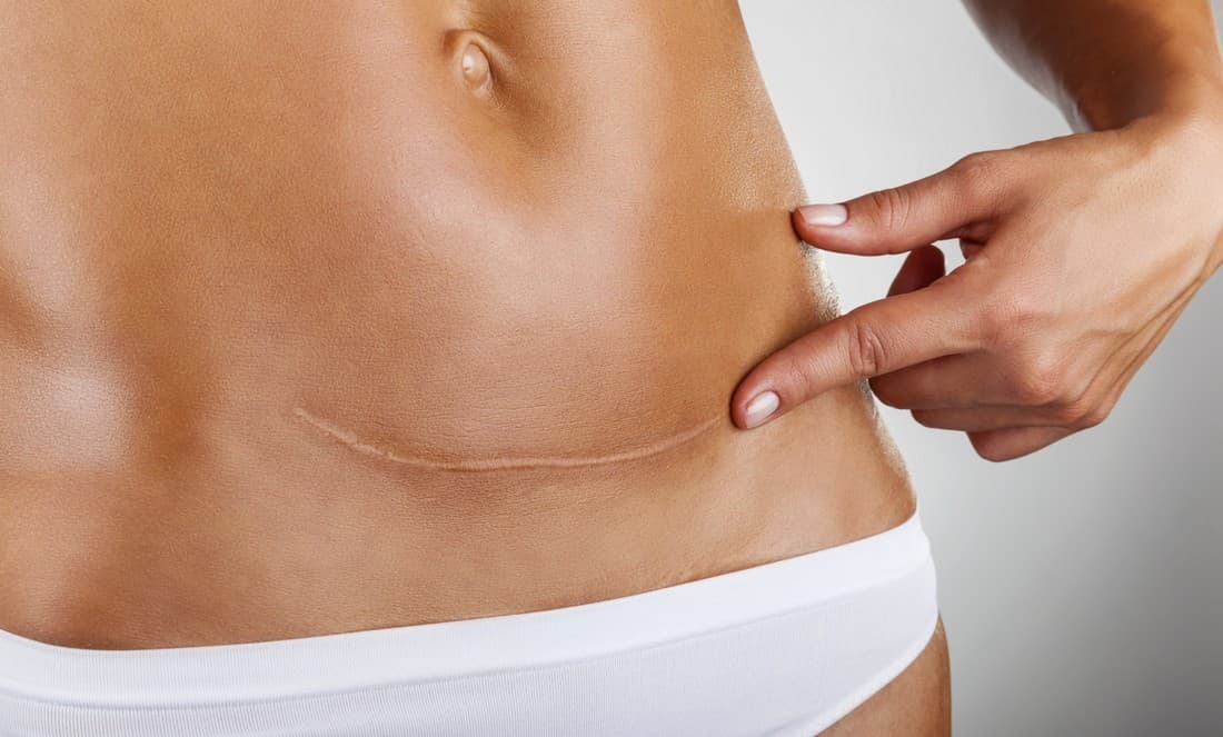 ¿Cuántas cesáreas puede soportar el cuerpo de una mujer?