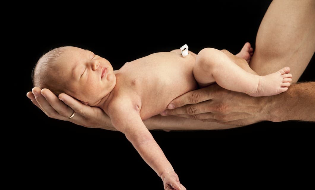 Así puedes identificar si tu bebé tiene granuloma umbilical y cómo debes tratarlo