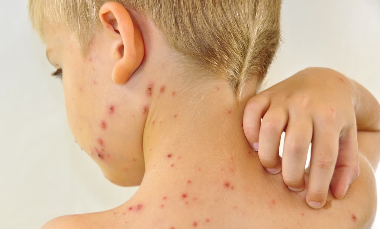 ¿Qué son las fiestas de varicela?