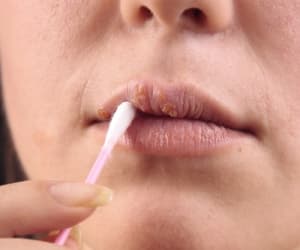 ¿Cómo evitar el herpes labial?