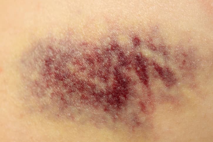 Cómo evitar los moretones de manera natural