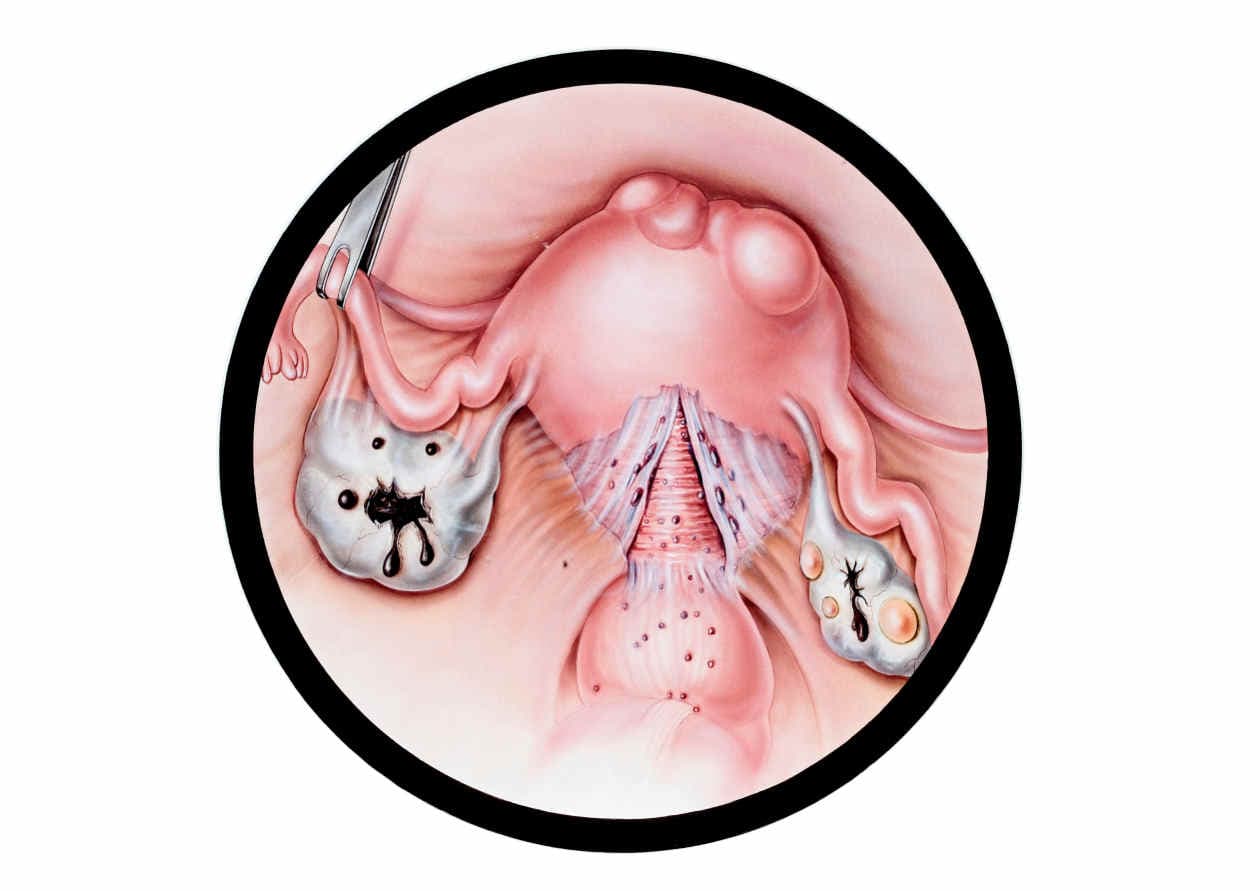 Cómo tratar la endometriosis naturalmente