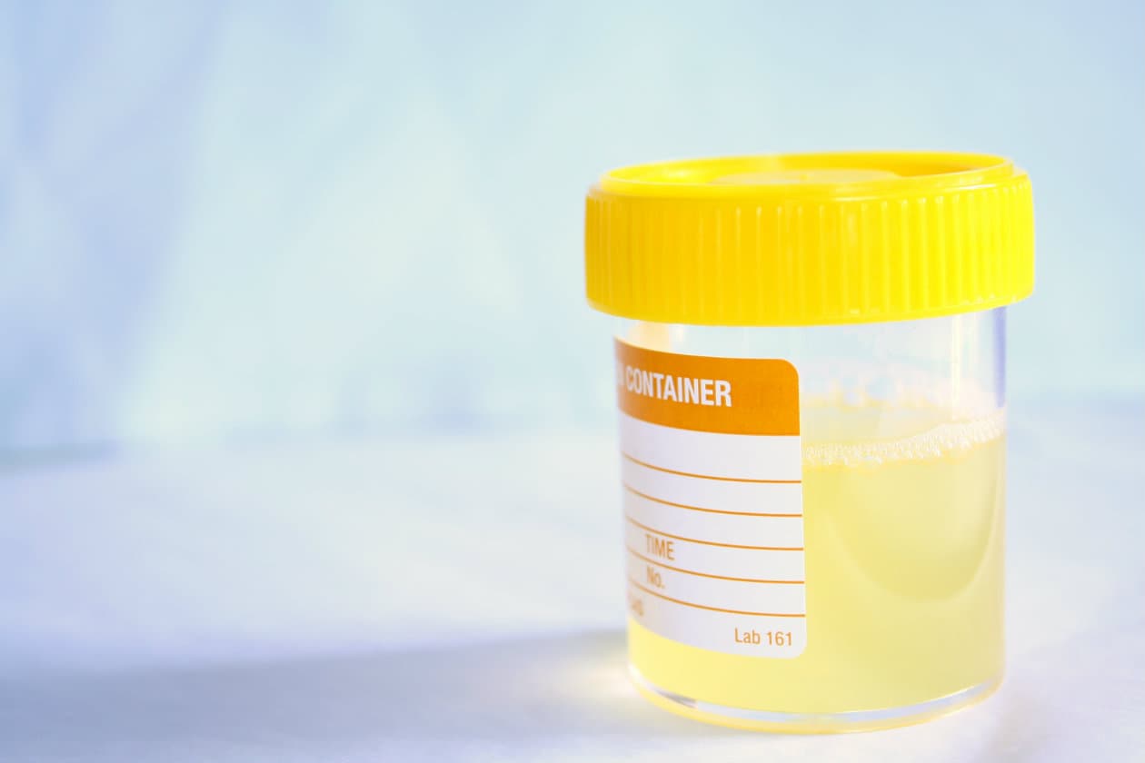 Dieta para el ácido úrico alto