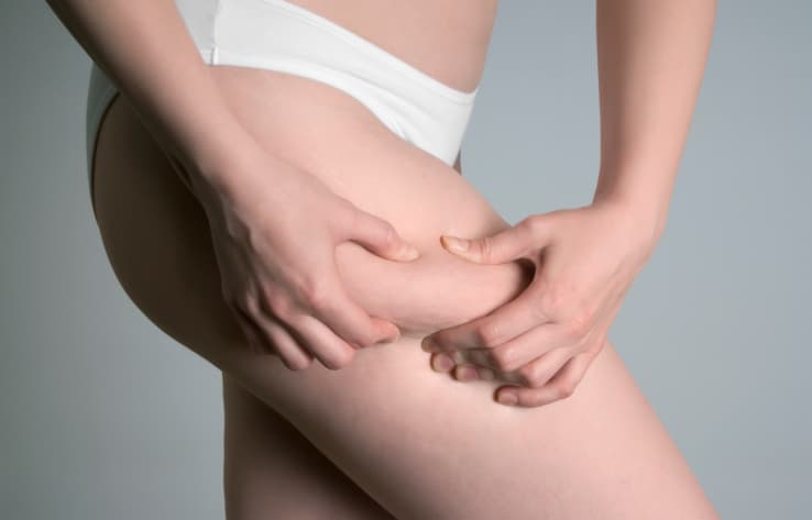 ¿Por qué las mujeres flacas también tienen celulitis?