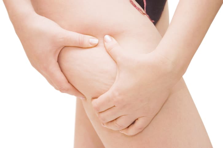 ¿Sabes cómo prevenir la celulitis?