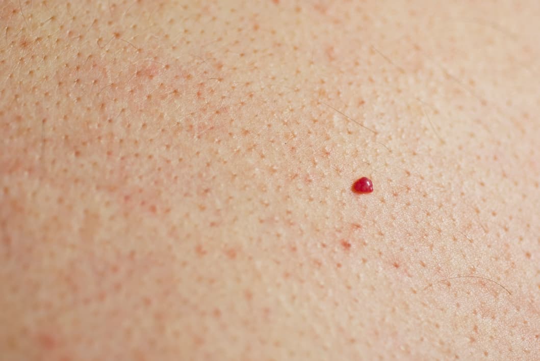 ¡Conviértete en una SkinChecker!, y prevén el cáncer de piel con esta APP