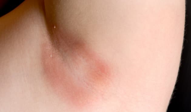 Tipos de hongos en la piel