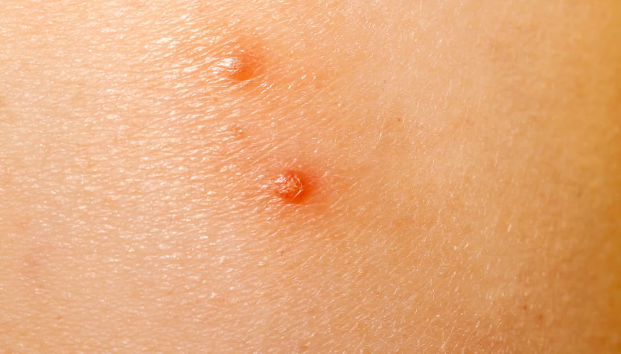 El molusco contagioso es común en los niños y puede tratarse de 4 maneras