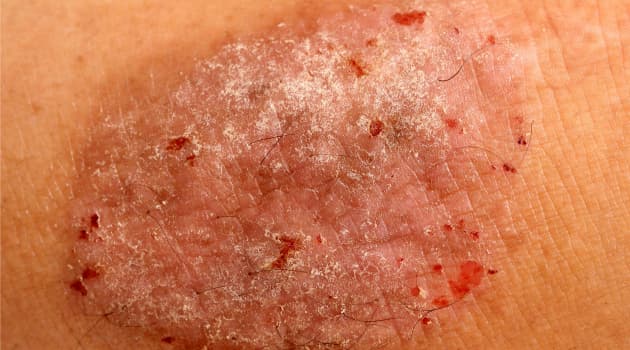 Brotes de psoriasis: dermatóloga recomienda 8 medidas para impedirlos
