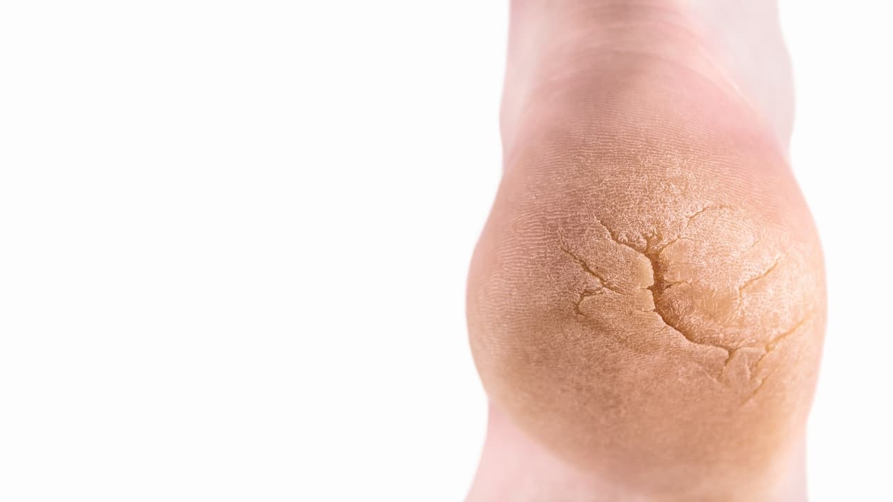 ¿Tienes los talones resecos o agrietados? 6 recetas naturales para devolverles la suavidad