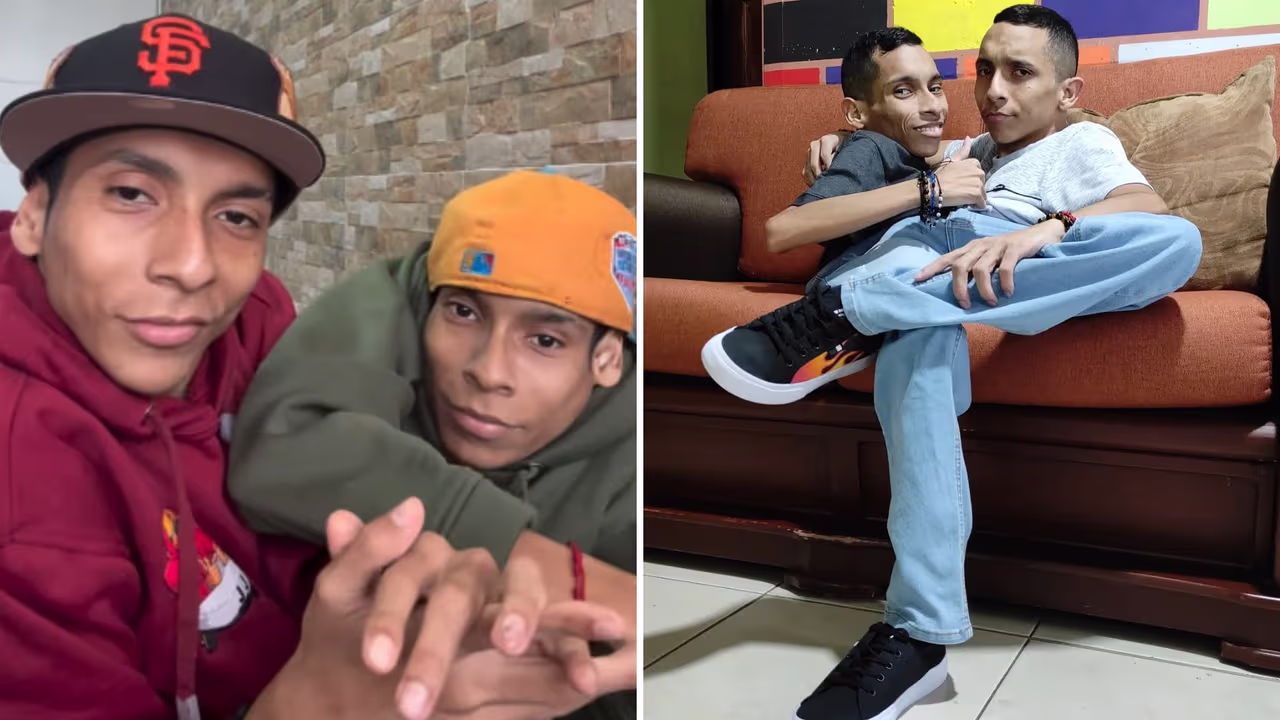 Mueren famosos siameses José Armando y José Luis Cevallos: soñaban con triunfar en la música