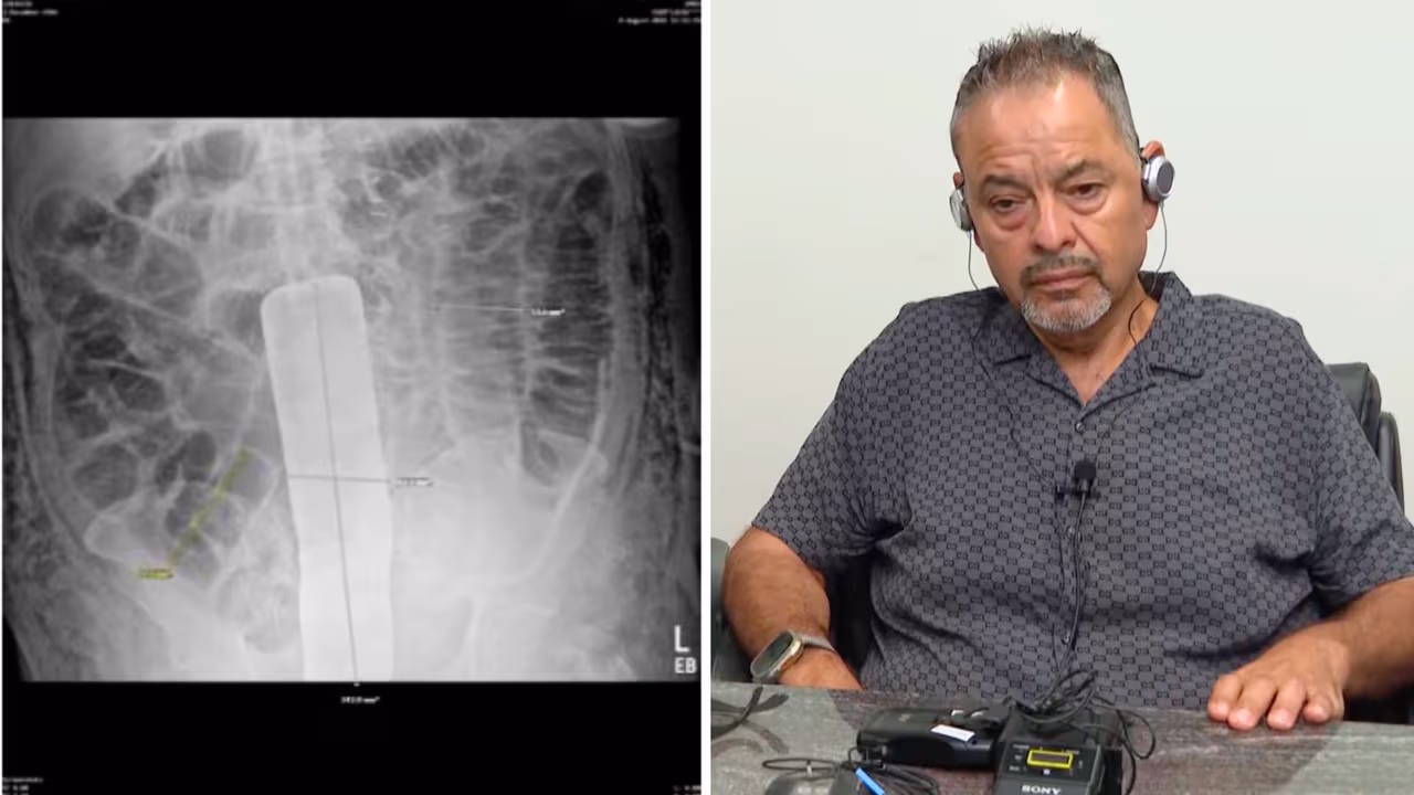 ダラスのヒスパニックは医学的エラーを非難します：彼らはテキサスでの手術後の腹部で物体を忘れました| Univision 23 Dallas ft。 Kuvnの価値