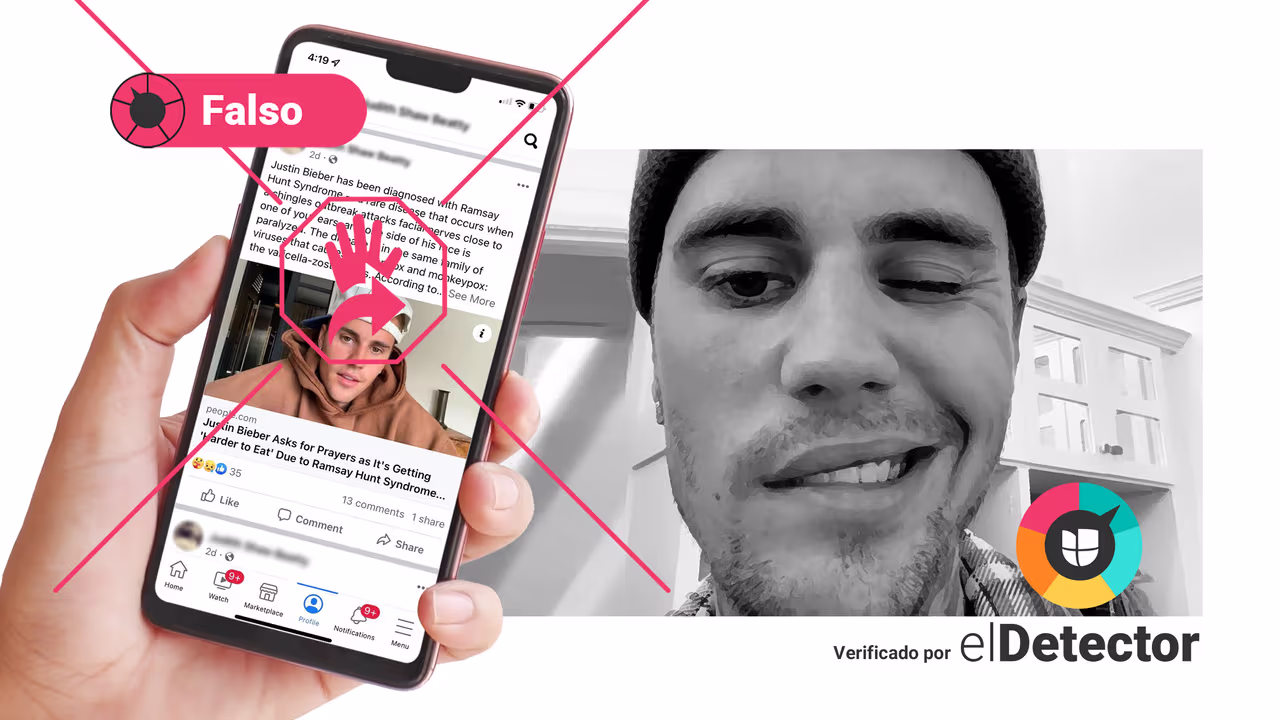 Image accompanying El síndrome Ramsay Hunt, que le provocó parálisis facial al cantante Justin Bieber, está relacionado con la viruela del mono