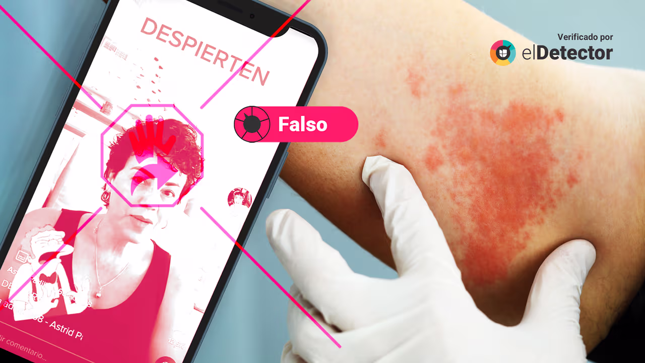 Image accompanying Las páginas de Pfizer y de la OMS pusieron “que uno de los efectos secundarios de la vacuna de Pfizer es el herpes zóster".