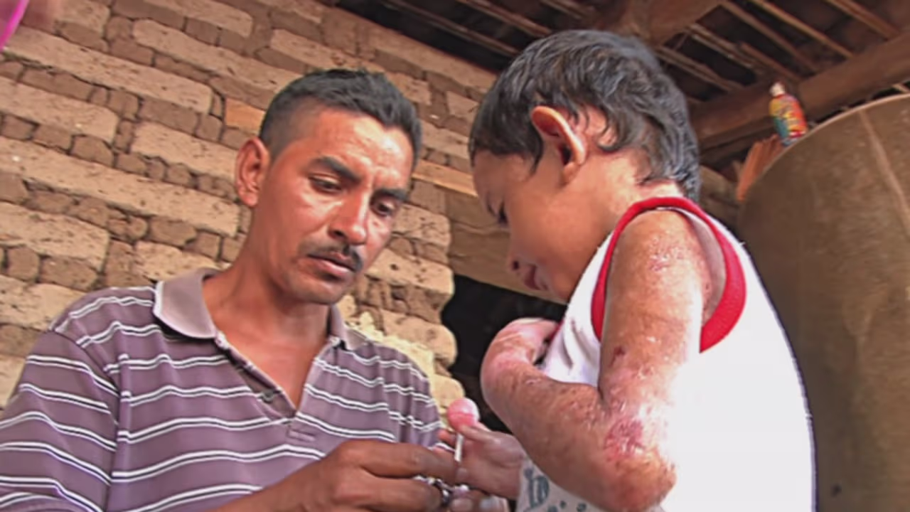 La extraña enfermedad de un niño que lo va dejando sin piel y para la ...